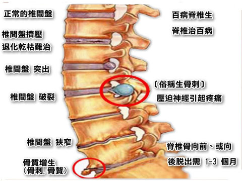 腰椎间盘突出症和坐骨神经痛